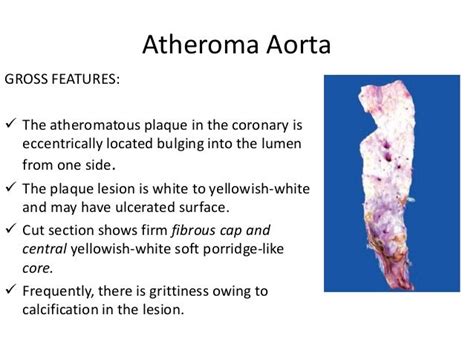 what is atheromatous aorta in tagalog|Atheroma: What It Is, Causes and Treatment .